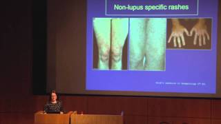 Lupus The Skin amp Hair  Dr Abby Macbeth East Anglia Lupus Info Day Oct 2013 [upl. by Oramug688]