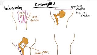 Osteomyelitis  Sequestrum Involucrum Draining sinus Explained [upl. by Vial]