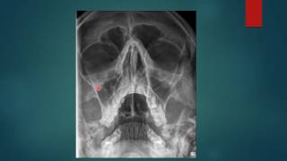 PARANASAL SINUSES RADIGRAPHY PNS X RAYS WATERS VIEW [upl. by Egiaf]