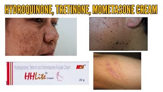 Hydroquinon tretinoin mometasone furoate cream  HH Lite Cream  Skinlite cream  No scar cream [upl. by Anaili719]