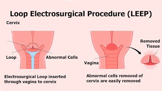 LEEP or Cone Biopsy Instructions [upl. by Euginomod]