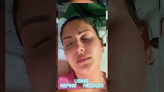 Lunchtime Microneedling prp prf microneedling lunchtime nodowntime brighteningserum [upl. by Tann]