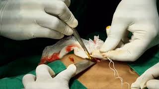 Open Appendectomy  Live surgical video [upl. by Dnalsor127]