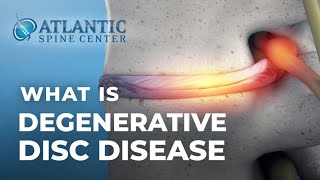 What Is Lumbar Degenerative Disc Disease  Intervertebral Disc Height Loss [upl. by Anidnamra]