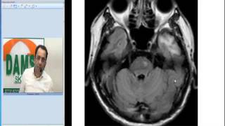 Radiology Spotters by Dr Sumer Sethi 34  Wallerian Degeneration [upl. by Stevens291]