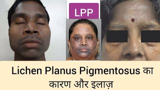 Lichen Planus Pigmentosus का कारण और इलाज़  lichenplanus  चेहरे और गर्दन के कालेपन का इलाज [upl. by Delila949]