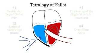 Tetralogy of Fallot [upl. by Amy]