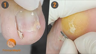 1 Difficult to access invertededge nails  2 Corns and calluses  2 cases 1 video VIII [upl. by Aluor757]