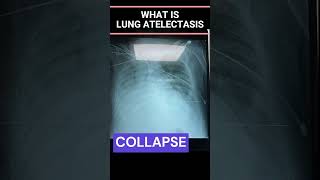 How To Remove Mucus from Lungs I Collapsed Lung I Atelectasis I Treatment [upl. by Innad]