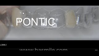 Pontic  facette dentaire en orthodontie par Aligneur et Invisalign [upl. by Irol]