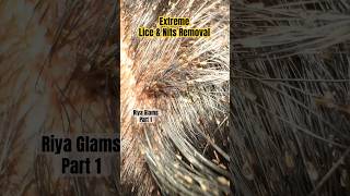 How to treat lice on hairlice treatment in Chennailice treatment in parlourlice removallice [upl. by Artemas]