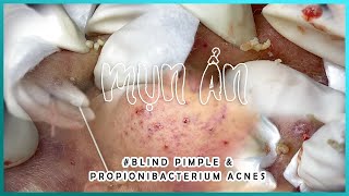 Big Cystic Acne Blackheads Extraction Blackheads amp Milia Whiteheads Removal Pimple Popping [upl. by Darleen]