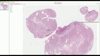 Hemangioblastoma  Adventures in Neuropathology [upl. by Ohs993]