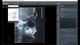 Cephalometric analysis [upl. by Jacobina]