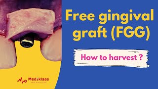 Free gingival graft  The technique [upl. by Yaja]