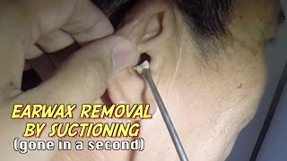 Earwax Removal by Suctioning Gone in a second [upl. by Uticas]