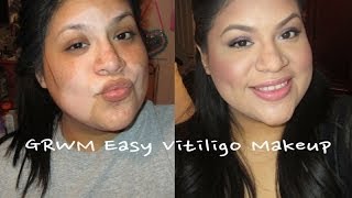 GRWM Easy Vitiligo Make Up [upl. by Eahsed]