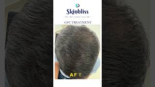 GFC Hair Procedure  Hair Loss  Hair fall treatment  Skinbliss Hair Clinic hairfalltreatment [upl. by Sirk]