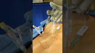 Injecting a facet cyst and having it spill out a needle in the cyst in the spinal canal [upl. by Shermy]