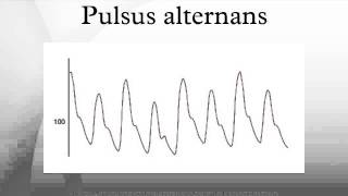 Pulsus alternans [upl. by Clive]