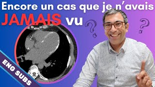 Une image JAMAIS vue  Calcifications myocardiques extensives [upl. by Clare307]