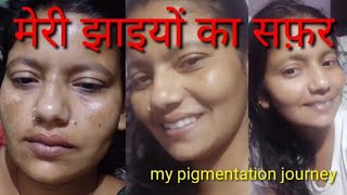 my pigmentation journey ll मेरी झाइयों का सफ़र ll how I remove my pigmentation ll झाइयों से छुटकारा [upl. by Kelwen178]