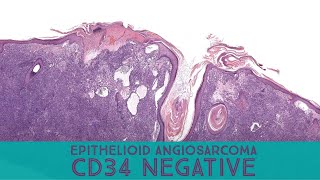 Epithelioid angiosarcoma CD34 negative Australasian Dermpath 2022  Case 11 pathology [upl. by Randell]