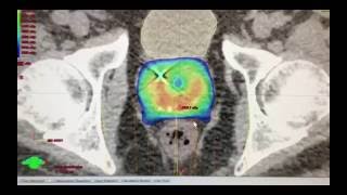 5Session Radiation Treatment For Prostate Cancer SBRT or Stereotactic Body Radiation Therapy [upl. by Nodab]