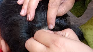 Lice Checking ASMR  Nit picking For Good Sleep picking A Lots of Lice [upl. by Ydnar]