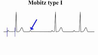 ECG Interpretation  AtrioVentricular Block [upl. by Rhodie783]