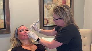 Microneedling with Nurse Angel [upl. by Ehcar]