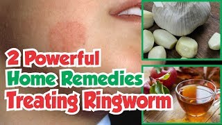 2 Powerful Home Remedies For Treating Ringworm [upl. by Trumann880]