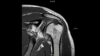 Retroversion of the glenoïd  complete MRI examination [upl. by Eixela]