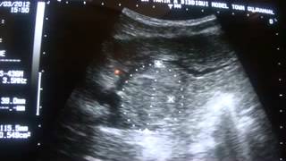 ultrasound HEPATOMA and its location [upl. by Kinson]