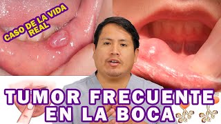 CÓMO ELIMINAR LOS MUCOCELES  TUMORES FRECUENTES DE LA BOCA [upl. by Attenohs]