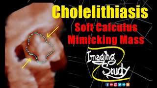 Cholelithiasis  Soft Calculus Mimicking Mass  Ultrasound  Case 317 [upl. by Oguh]