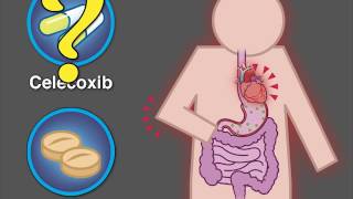 Cardiovascular Safety of Celecoxib  NEJM [upl. by Resneps688]