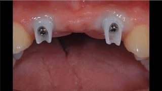 From Intraoral Scan to Final Custom Implant Restoration Vol 2 Issue 4 [upl. by Kosey]