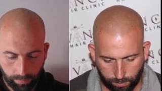 José´s Hair Loss Journey to Vinci Hair Clinic and Scalp Pigmentation [upl. by Ibur]