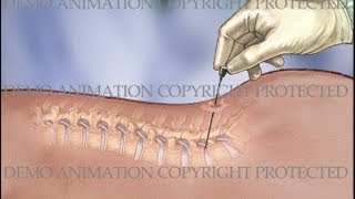 Lumbar IDET Intradiscal Electrothermal Therapy Procedure [upl. by Mojgan]