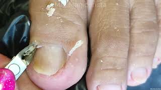 Toenail Ingrown Removalang daming nakuha [upl. by Hizar]