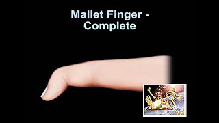 Mallet Finger Complete  Everything You Need To Know  Dr Nabil Ebraheim [upl. by Hteboj117]