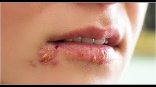 Shingles Contageous Asbestos Shingles Herpes Zoster Pain Duration Symptoms For Herpes [upl. by Downe]