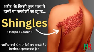 shingles disease symptoms causes treatment and vaccine information in hindi [upl. by Arrec480]