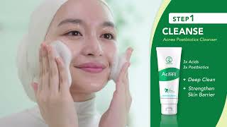 Acnes 3 Simple Steps to AcneFree Skin [upl. by Alithea]