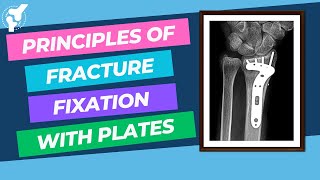 Principles of Fracture Internal Fixation With Plates and Screws  Material Properties [upl. by Naamann552]