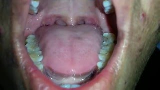 Tongue Fasciculation in MND [upl. by Anazus]