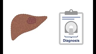 Diagnosing hepatocellular carcinoma using CT [upl. by Gnoc]