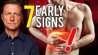 7 Early Signs of Liver Damage [upl. by Enaelem]