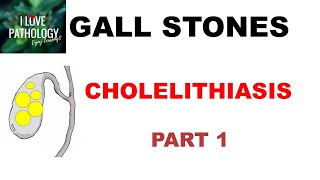 CHOLELITHIASIS GALL STONESPart 1 Epidemiology Types Risk factors [upl. by Eiramac665]